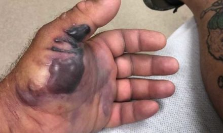 One Little Cut From a Fish Hook, and a Flesh-Eating Bacteria Almost Took This Guy’s Arm