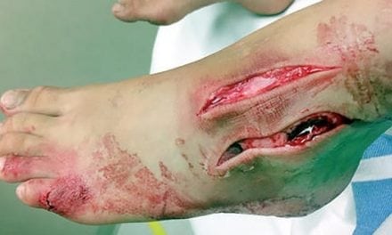 Was This Duluth Girl Bitten By a Muskie…Or an Otter?