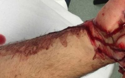 GRAPHIC: This Horrific Hunting Accident is Hard to Look At