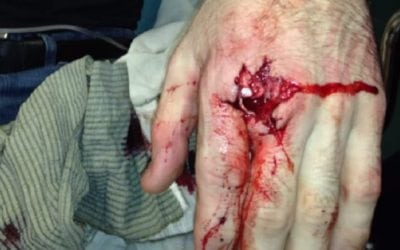 Gun Safety Lesson: One Man’s Story of How He Shot His Finger Off