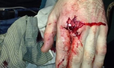 Gun Safety Lesson: One Man’s Story of How He Shot His Finger Off
