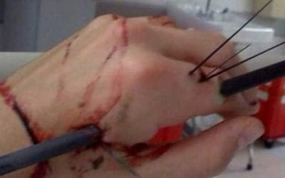 The 5 Most Common Hunting Injuries