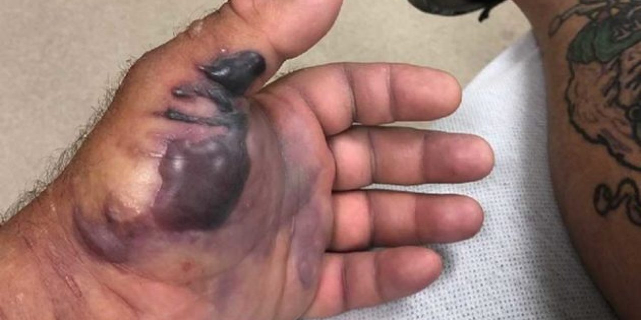 One Little Cut From a Fish Hook, and a Flesh-Eating Bacteria Almost Took This Guy’s Arm