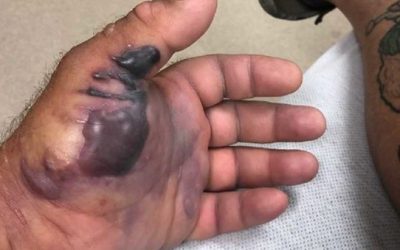 One Little Cut From a Fish Hook, and a Flesh-Eating Bacteria Almost Took This Guy’s Arm