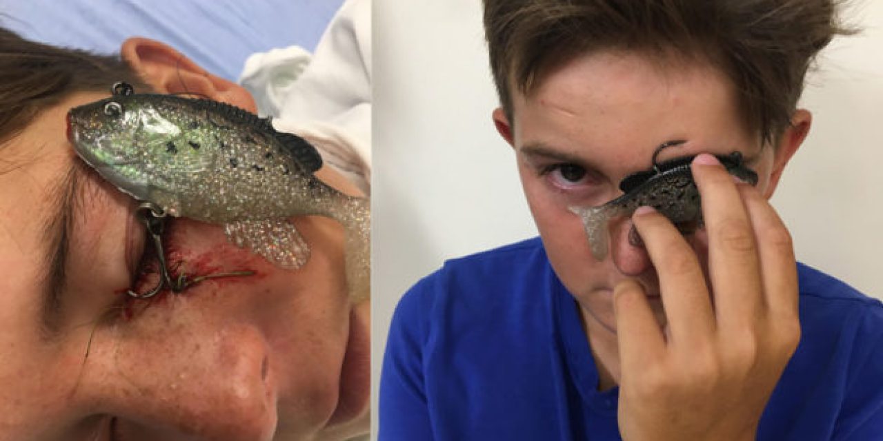 11-Year-Old Takes a Fish Hook to the Eyelid