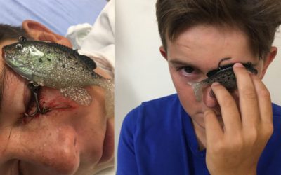 11-Year-Old Takes a Fish Hook to the Eyelid