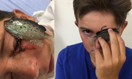 11-Year-Old Takes a Fish Hook to the Eyelid
