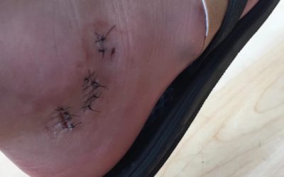 Muskie Bait: Wisconsin Lad Gets 16 Stitches From Muskellunge Bite