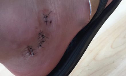 Muskie Bait: Wisconsin Lad Gets 16 Stitches From Muskellunge Bite