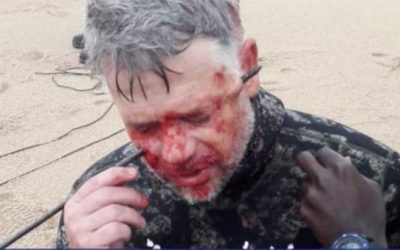 Crazy Mishap Sends Spearfishing Arrow Through Man’s Head