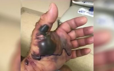 Fish Hook, Flesh-Eating Bacteria Nearly Took Fisherman’s Arm